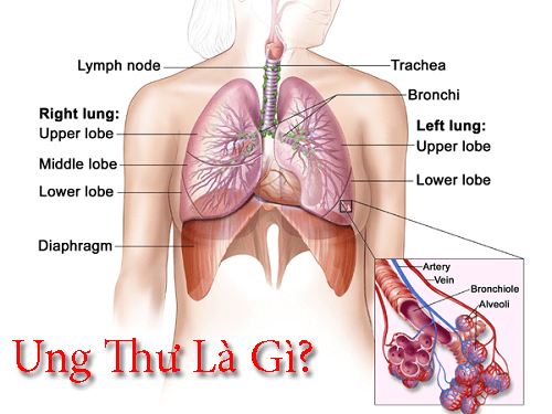 Bệnh Ung Thư Là Gì? Nguyên Nhân Nào Dẫn Đến Ung Thư?