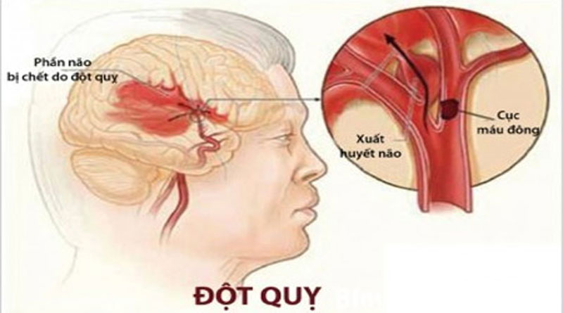 Đột Quỵ Là Gì? Tìm Hiểu Về Đột Quỵ Là Gì?