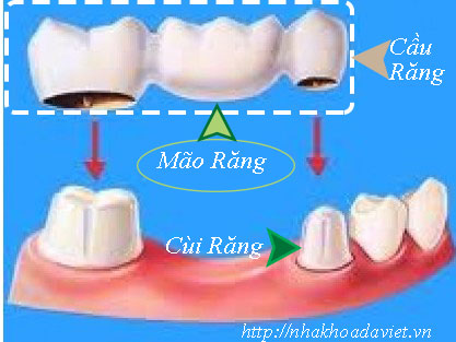Mão Răng Là Gì?  Tìm Hiểu Về Mão Răng Là Gì?
