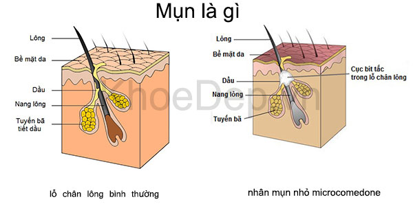 Mụn Là Gì? Tìm Hiểu Về Mụn Là Gì?