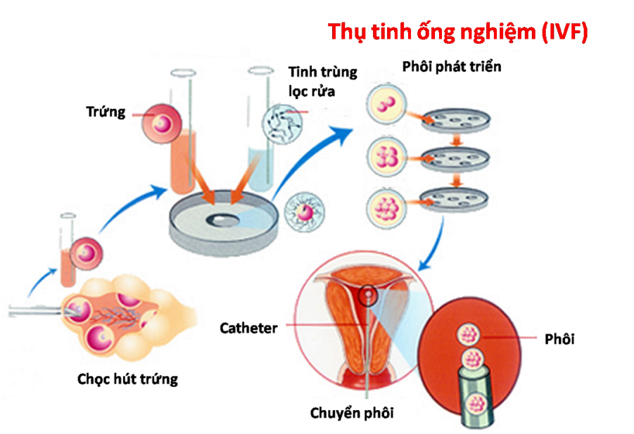 Tìm Hiểu Về Thụ Tinh Trong Ống Nghiệm Là Gì?